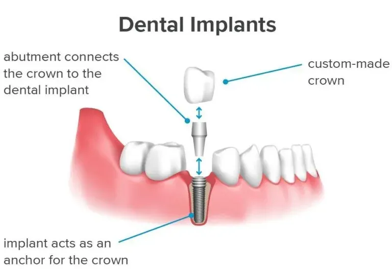 Dental Implant