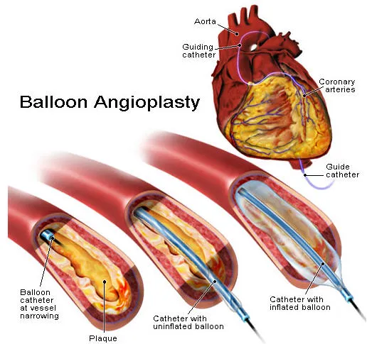 Interventional Cardiology