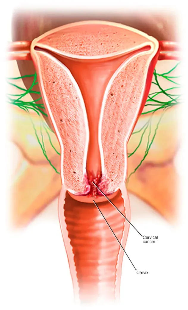 Cervical Cancer Treatment
