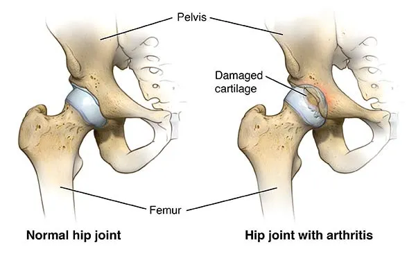 Hip Replacement Surgery